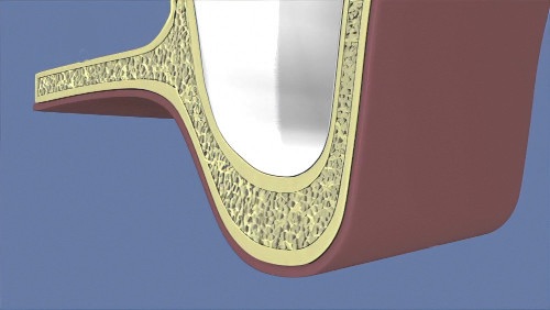 chirurgie pré-implantaire Nîmes Sinus Lift